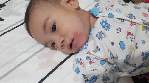 แพ้ซีรีแลค