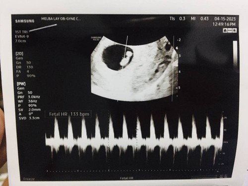 6 weeks and 4 days with heartbeat ❤️