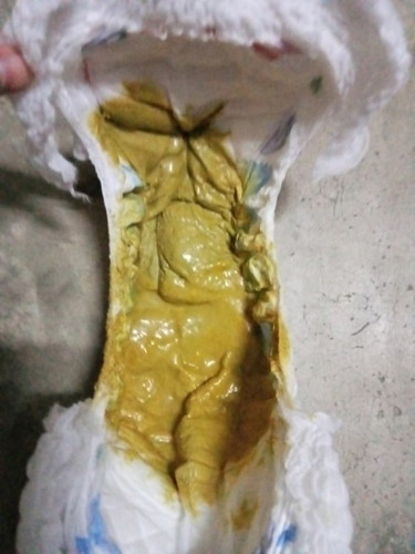 ลูก 9 เดือน ถ่ายแบบนี้ปกติไหมคะ