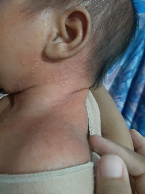 Mau nanya dong moms , kira2 ini knapa ya ? Terus recommend dong obat buat ngilangin bruntusanya