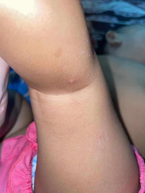 baby 9 bulan kena cikenpox