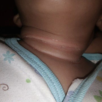 Leher bayi merah dan ngelupas