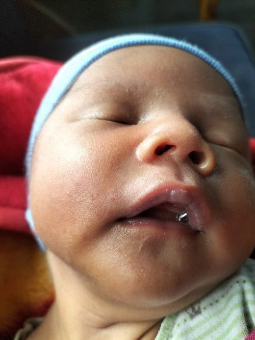 Bibir anakku seperti ini Bun .kira kira kenapa yah ? Umur seminggu anakku