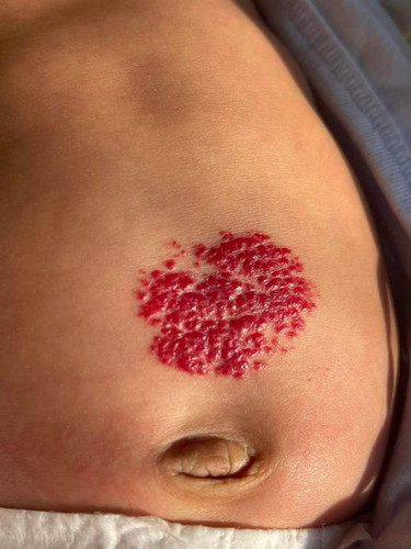 Hemangioma