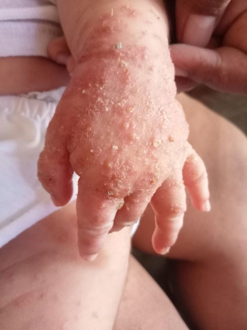 Cacar air bayi 1 buln