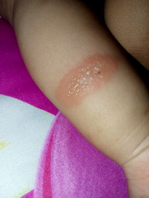 #Akibat gigitan nyamuk