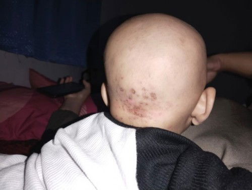 Gatal gatal kepala bayi 7bln