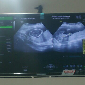 Malam bun..  Aku sedang hamil usia 17wek dgn brrat janin 190 gram., ada yg sama kah dngn aku bun?