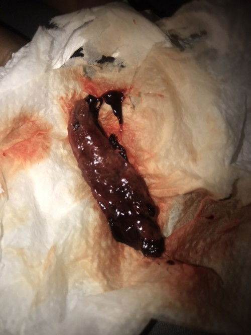 ขอสอบถามหน่อยค่ะ เมื่อ4วันเราไปรพ คุณหมอบอกเราแท้งค่ะ ได้นอนรพ1คืนและหมอให้กลับมาดูอาการที่บ้านต่อ