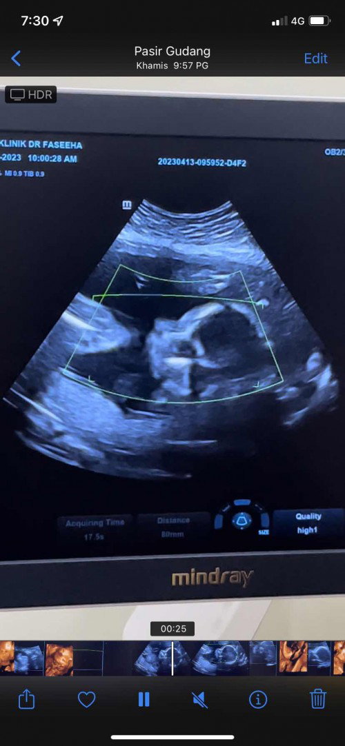 23week pregnantcy