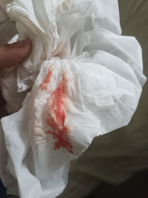 เลือดออกขณะตั้งครรภ์