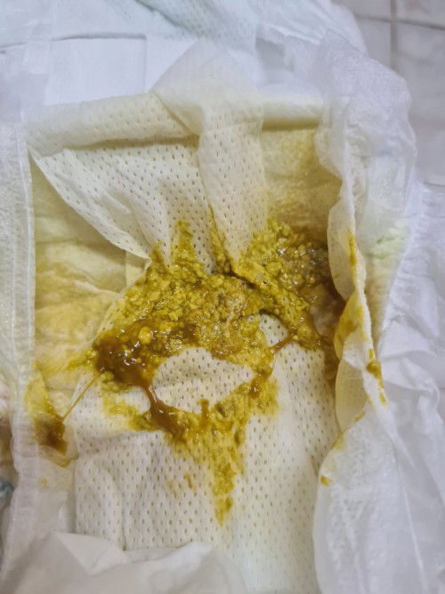 Bé 5 tháng rưỡi bị tiêu chảy