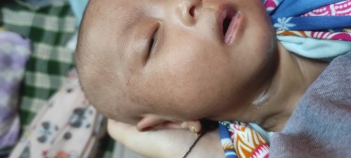 Cara mengatasi ruam kemerahan