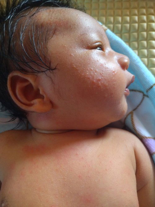 แบบนี้เป็นผื่นแพ้หรือผื่นร้อนคะ