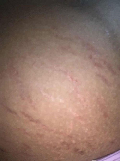 Stretchmark