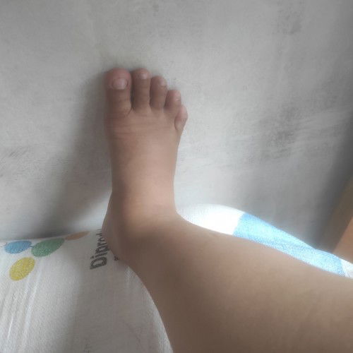 Bun kenapa habis oprasi SC hari ke5 kaki saya jadi bengkak? Apakah itu normal?