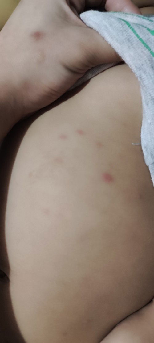 Tigdas, insect bites or bulutong?
