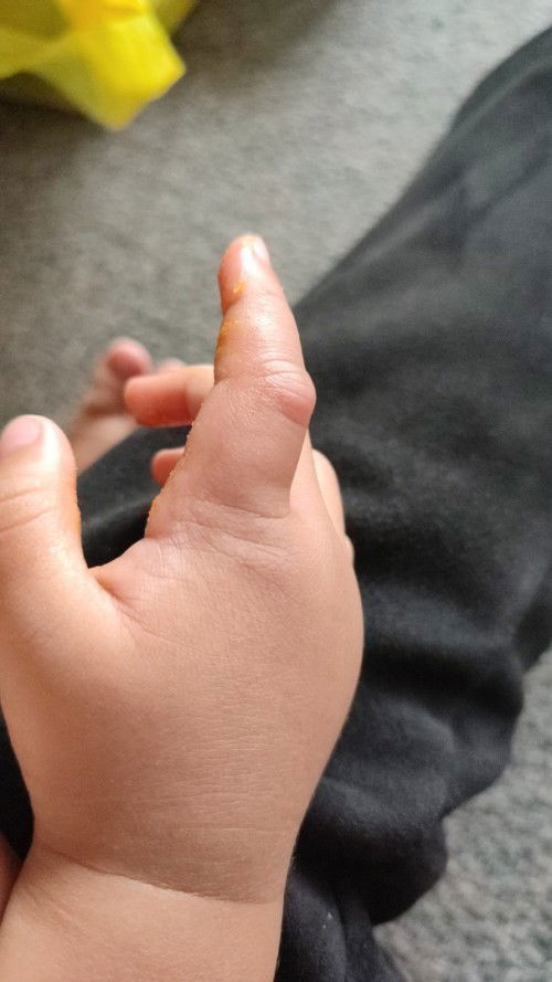 Tangan dan jari anak bengkak