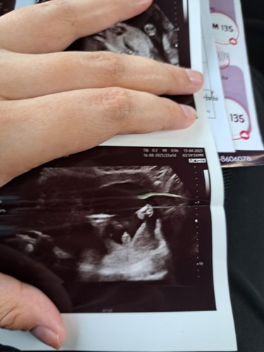Gender Baby