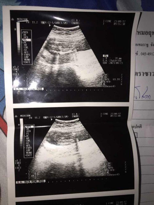 ท้องได้ 20w+4