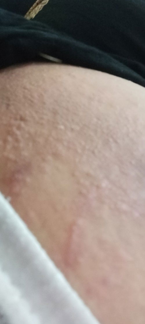 Cara nyembuhin gatal2 pasca melahirkan Cesar di area perut