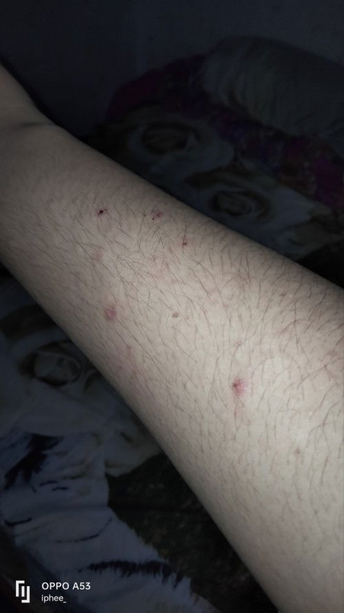 Usia kandungan 23 week, tapi ditangan sma muka timbul bintik" gatal, apakah wajar bun?