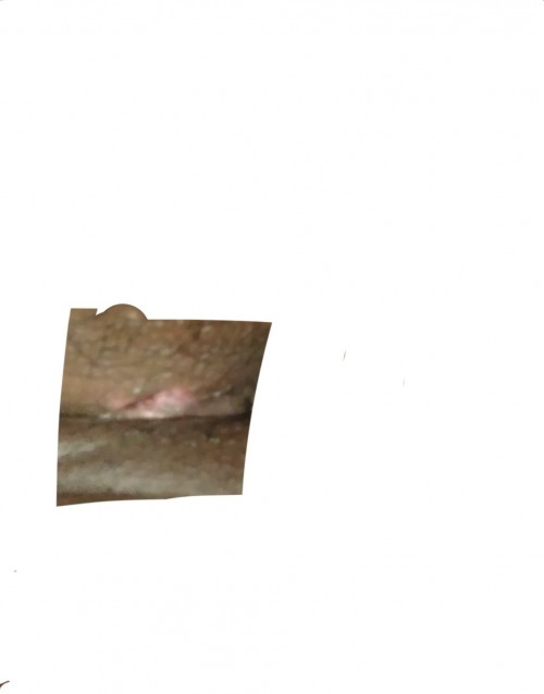 พอดีอยากจะสอบถามค่ะว่าแบบนี้คือแผลปริมั้ยคะ