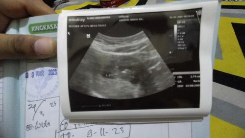 Usg 9w3d Alhamdulillah janin udah keliatan dan sehat udah gerak" diwaktu usg