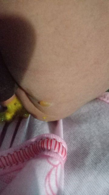 Tubuh bayi tumbuh bentol nanah