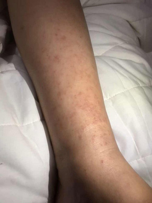 Muncul gatal setelah beberapa hari suntik pematangan paru