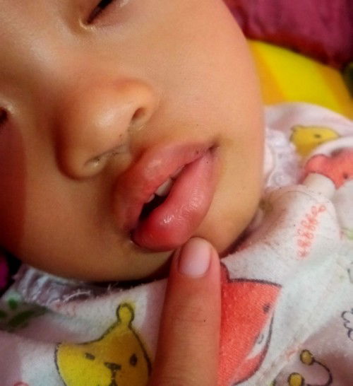 Sariawan dan bibir ada benjolan
