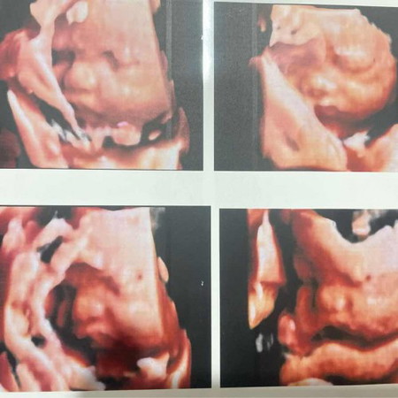 31+4 น้ำหนักลูก 2,100