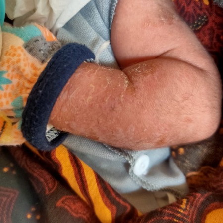 Kulit bayi usia 2 minggu