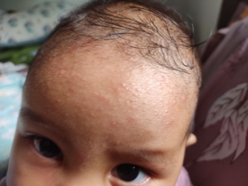 Biang keringat kyk gini dikasi apa ya bun?