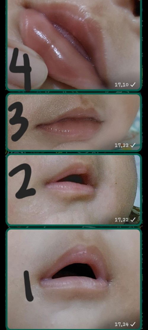 Bibir bayi bagian dalam hitam usia 4 bulan