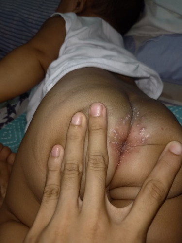 RASHES SA PWET