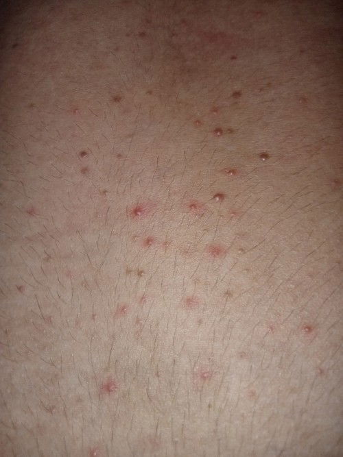 ขอถามหน่อยค่ะมีใครเคยเป็นตุ่มคล้ายๆตุ่มสิวไหมคะ