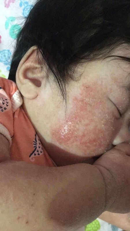 Will share po, para po sa mga may atopic dermatitis/eczema. Worth it po basahin