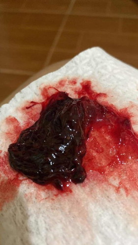 Severe nose Bleeding