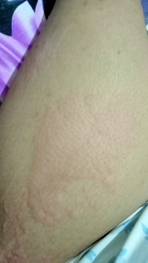 Biduran ibu menyusui