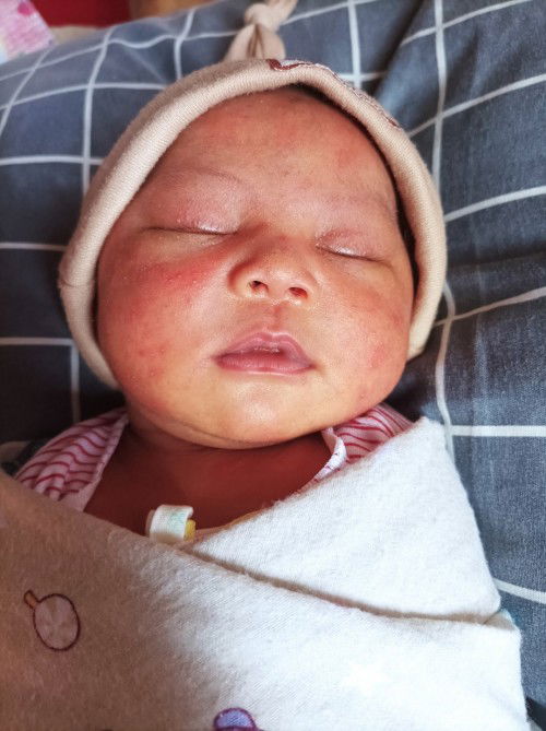 Kulit bayi merah bintik