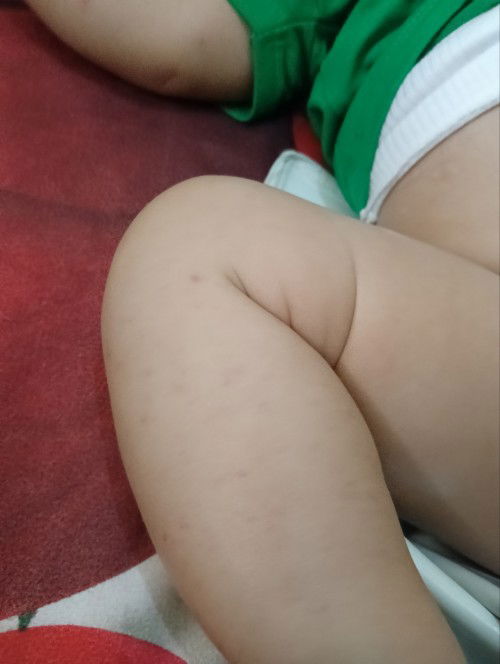 mom anak saya kenapa ya selalu bintik merah, kadang hilang nanti muncul lagi? mohon di jawab 🤝👏