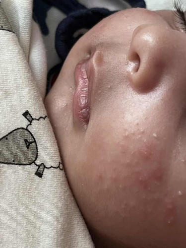 Spots on newborn’s face