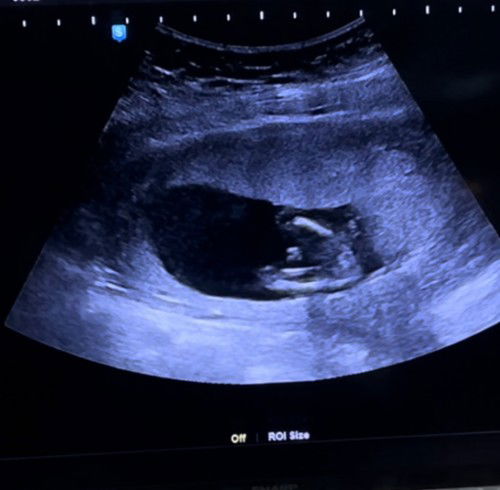 สอบถามประสบการณ์แม่ๆค่ะ