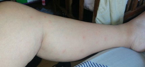 Hi mga mommies sino nagka ganto nung preggy? Grabe ung kati nya btw I'm 37 weeks preggy. Nag start