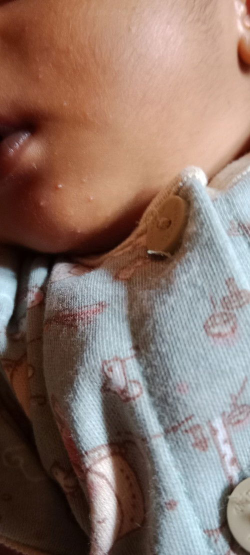 Bintik merah pada bayi