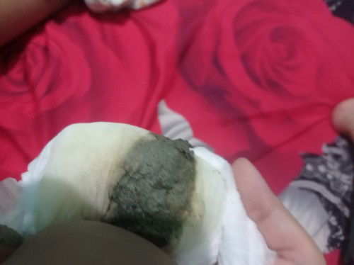 Feses bayi bewarna abu abu usia 11 bulan