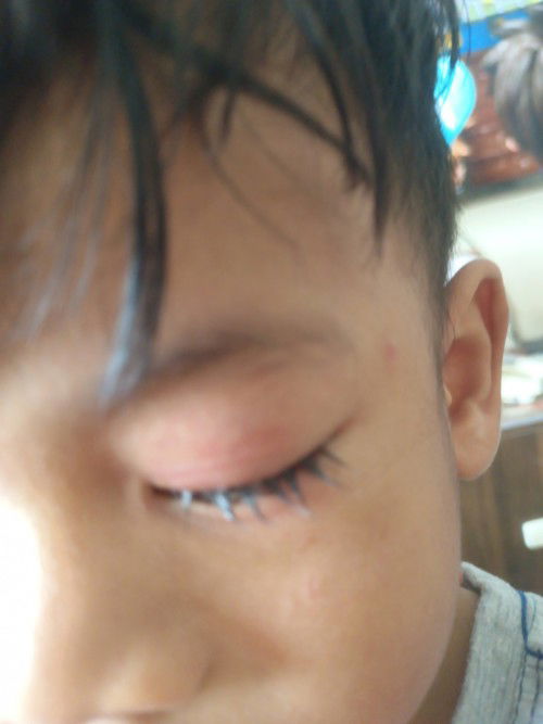 mata berair tahi mata