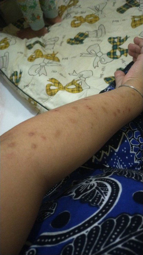 Gatal gatal ditangan dan kaki