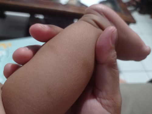 Bekas gigitan nyamuk